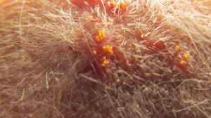 Harvest Mites